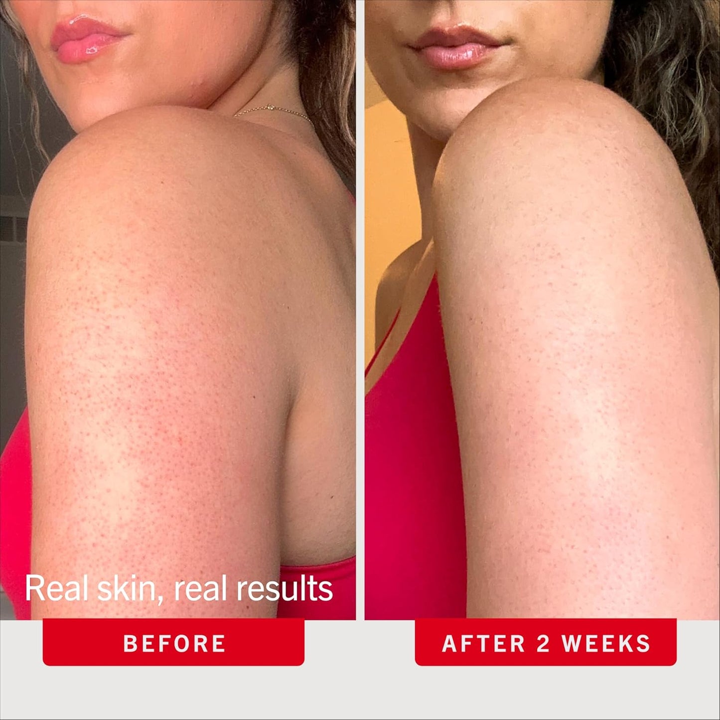 KP Bump Eraser Body Scrub with 10% AHA, Keratosis Pilaris Skin Exfoliator with Glycolic and Lactic Acids