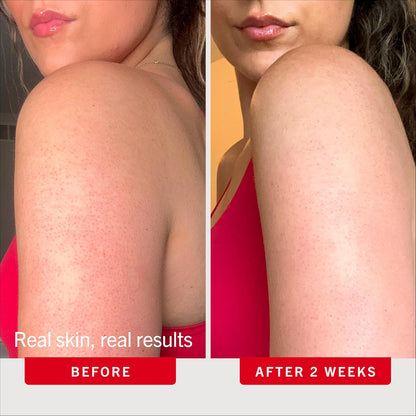 KP Bump Eraser Body Scrub with 10% AHA, Keratosis Pilaris Skin Exfoliator with Glycolic and Lactic Acids